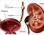 calculos-renales-o-vesicales-enfermedad-comun-del-rinon-o-de-vias-urinarias imagen de artículo