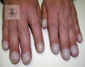 fibrosis-pulmonar-una-enfermedad-progresiva imagen de artículo