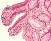 Colonoscopia: estudio para la revisión de colon