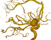 aneurisma-dilatacion-arterial imagen de artículo