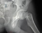 Osteoporosis: disminución de los huesos