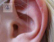 Otoplastia: cirugía para orejas prominentes