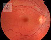 degeneracion-macular-enfermedad-lenta-y-progresiva imagen de artículo
