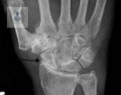 Osteoporosis: riesgo de fractura constante