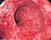 colitis-padecimiento-ocasionado-por-estres-y-mala-alimentacion imagen de artículo