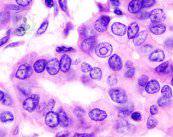 cancer-de-tiroides-enfermedad-de-origen-desconocido-parte-1 imagen de artículo