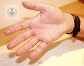 hiperhidrosis-sintomas-frecuentes-parte-2 imagen de artículo