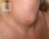 Nódulo tiroideo: enfermedad generalmente inofensiva (Parte 1)