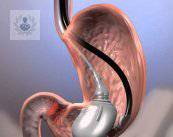 balon-gastrico-tratamiento-no-quirurgico-para-la-obesidad-parte-1 imagen de artículo