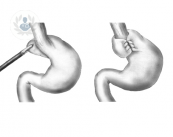 funduplicatura-solucion-para-el-reflujo-gastrico imagen de artículo