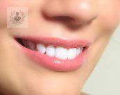 blanqueamiento-dental-tratamiento-recomendable-y-seguro imagen de artículo