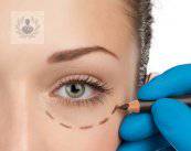 blefaroplastia-rejuveneciendo-los-parpados imagen de artículo