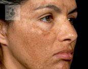 manchas-en-la-cara-podria-ser-melasma imagen de artículo