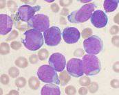 Leucemia linfoblástica aguda: enfermedad con predisposición genética