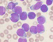 leucemia-linfoblastica-aguda-enfermedad-con-predisposicion-genetica imagen de artículo