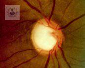 Glaucoma: enfermedad silenciosa