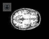 epilepsia-como-se-detecta imagen de artículo
