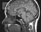 malformacion-de-chiari-que-es-y-como-se-detecta imagen de artículo