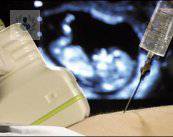 diagnostico-prenatal-tecnicas-e-indicaciones imagen de artículo