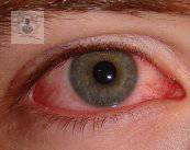 Uveítis: enfermedades inflamatorias oculares