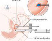 Biopsia de próstata: herramienta fundamental para la detección de cáncer