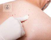 melanoma-cancer-en-la-piel-causado-por-rayos-solares imagen de artículo