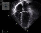 ecocardiograma-estudio-que-ayuda-a-detectar-cualquier-enfermedad-del-corazon imagen de artículo