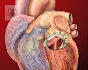 valvula-mitral-hallazgo-inesperado-de-un-mal-funcionamiento imagen de artículo