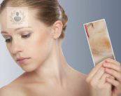 Dermatitis: factores que influyen en la irritación de la piel