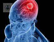 Infarto cerebral: síntomas y causas