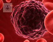 mieloma-multiple-signos-y-sintomas-parte-3 imagen de artículo