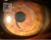 queratocono-enfermedad-causante-de-la-perdida-de-vision imagen de artículo