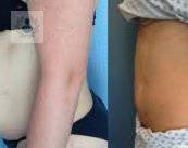 abdominoplastia-para-el-tratamiento-de-hernias imagen de artículo