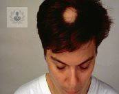 Alopecia: qué es y cómo tratarla