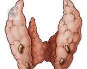 hiperparatiroidismo-produccion-excesiva-de-la-glandula-paratiroides-parte-1 imagen de artículo