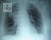 Neumonía: insuficiencia respiratoria aguda (P2)