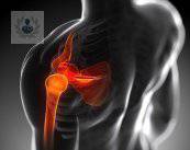 tendinitis-manguito-rotador-y-lesiones-comunes-del-hombro-p2 imagen de artículo