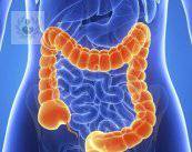 Cáncer de colon, apéndice y recto: prevención y tratamiento