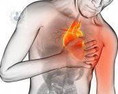 Infarto cardíaco: obstrucción arterial peligrosa