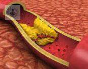 enfermedad-arterial-periferica-obstruccion-arterial imagen de artículo