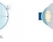 miopia-y-el-tratamiento-smile-el-mas-avanzado-en-la-actualidad imagen de artículo