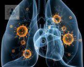 Neumonia: insuficiencia respiratoria aguda (P3)