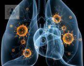 neumonia-insuficiencia-respiratoria-aguda-p3 imagen de artículo