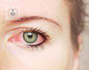 glaucoma-presion-intraocular-intensa-p1 imagen de artículo