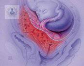 Placenta previa: ¿riesgo de muerte?
