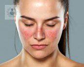 lupus-la-importancia-de-tratarlo-a-tiempo imagen de artículo