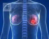 Breast cancer: failure of the cell replacement process (P2)