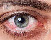 que-es-el-sindrome-del-ojo-seco imagen de artículo
