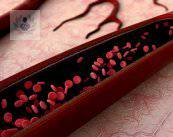 vasculitis-tipos-diagnostico-y-tratamiento imagen de artículo