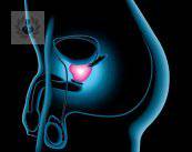 Crecimiento benigno de la próstata y cáncer de próstata